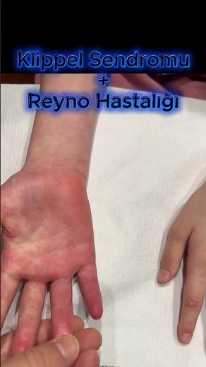 Klippel-Trénaunay Sendromu ve Reyno Hastalığı Aynı Hastada — Prof. Dr. Ahmet AKGÜL