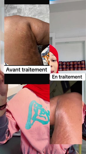 #hyperpigmentation #debloquemesvue🥲🙏🏽 #savoneclaircissant #debloquemesvue🥲 #debloquemesvue🥲