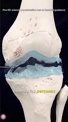 Visco Gel Injection For Treatment of Knee Osteoarthritis (3D Animation)#3dmedicalanimation #doctor