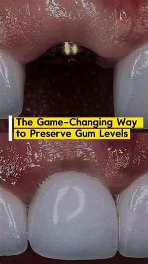 The Socket Shield Technique: A game-changing way to preserve gum levels. #surgicalmaster
