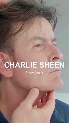 🎬 Unveiling Charlie Sheen’s SurgYlift Results “SurgYlift is giving me the confidence I haven’t felt in a long time,” declares Charlie Sheen (@charliesheen). Today, we reveal the extraordinary results of Charlie Sheen’s Y LIFT and SurgYlift procedures. Previously, his “turkey gobbler” neck, as noted by Fox News, impacted how he appeared on camera. Today, that moment is a thing of the past, as Charlie Sheen emerges with newfound confidence after his SurgYlift transformation. With SurgYift’s revol