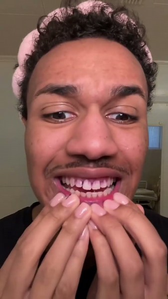 THE ONLY WHITENING METHOD THAT DOESN'T LEAVE WHITE SPOTS ON MY GUMS