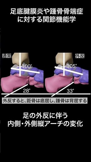 足底腱膜炎・踵骨骨端症と距骨下関節機能障害