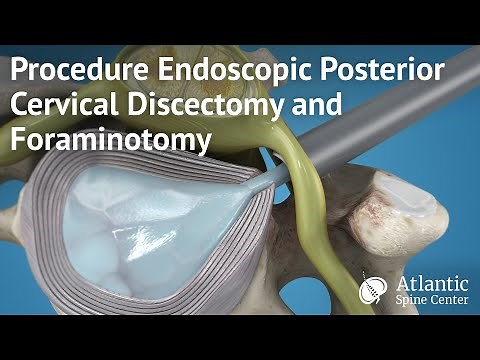 Procedure Endoscopic Posterior Cervical Discectomy and Foraminotomy