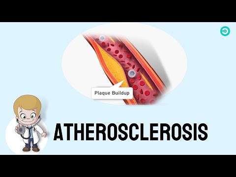 Coronary Atherosclerosis (Arteriosclerotic Heart Disease): Medical animation