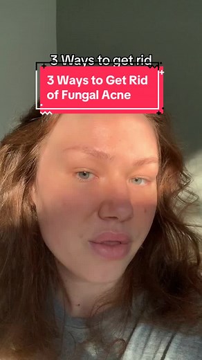 3 Ways to Get Rid of Fungal Acne | Skincare Routine