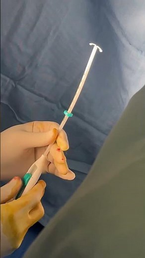 Mirena coil insertion.👍✨ #birth-control