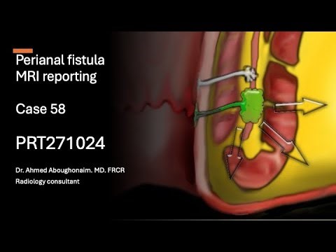 | Case 58 | Perianal Suprasphincteric fistula Grade 5 with two side-branch | PRT271024