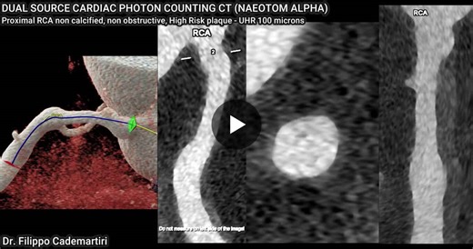 #pcct #photoncountingct #coronaryatherosclerosis #earlydetection #preventivecardiology #cardiacct #plaqueimaging #cardiovascularimaging #radiologyinnovation #yescct | Dr. Filippo Cademartiri