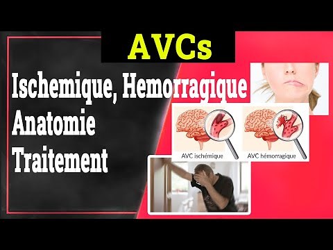 Accident Vasculaire Cérébral (AVC): Symptômes, Types, Traitement | Neurologie