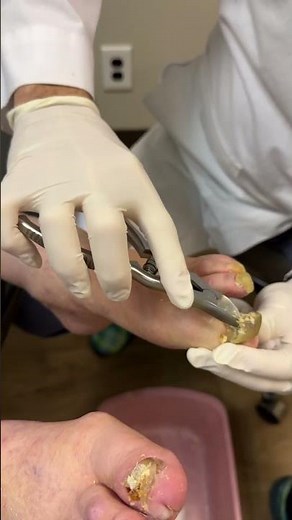 Extreme Toenail Transformation: One Year of Untouched Toenails!😳