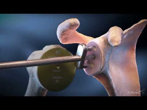 Univers Apex OptiFit™ Surgical Technique