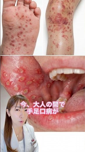 【緊急警告】大人の手足口病が激痛すぎる。初期症状と今すぐできる対策を解説。