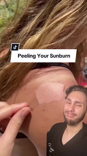 Peeling a sunburn might be satisfying to watch, but easily one of the worst things you can do. Peeling a sunburn can lead to hyperpigmentation, scarring, and blistering from repeat sun exposure. #antisunscreen #sunprotection #sunburn #suntan #tanned #medicalaesthetician #aestheticsnurse
