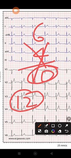 ECG Basic knowledge|ECG Part 1 | How to Read ECG | #ecg #doctor #bams #bhms #bums #medicalpractice