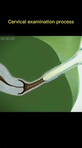 Understanding Pregnancy: Cervical Examination Explained