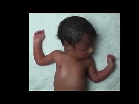 Tachypnea,Grunting,Subcostal Retractions and Intercostal retractions DR TMAM