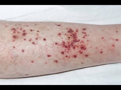 Signs of allergic vasculitis, hypersensitivity vasculitis or leukocytoclastic vasculitis