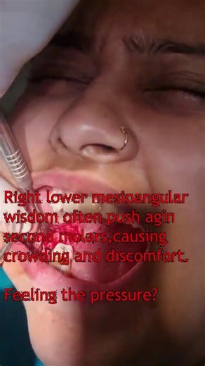 Mesioangular wisdom tooth removed to prevent crowding and second molar damage. #dentist #teethdecay