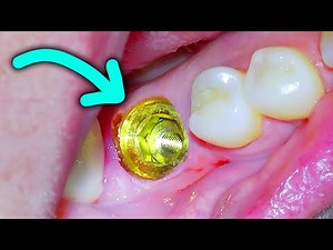 Dental Implant Procedure To Replace A Single Missing Tooth on a Back Molar • Video • MEDtube.net