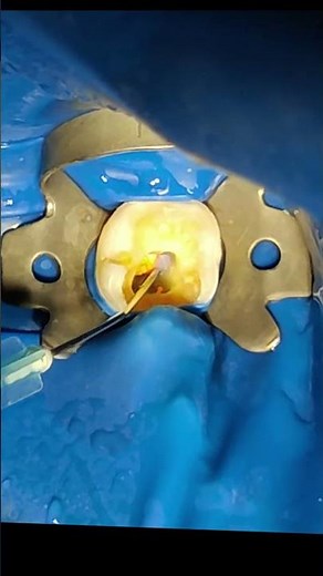 👉 "Root Canal Treatment Step by Step | Pain, Cost & Recovery Explained"