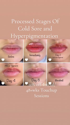 Understanding the Stages of Cold Sore: Prevention and Treatment Tips