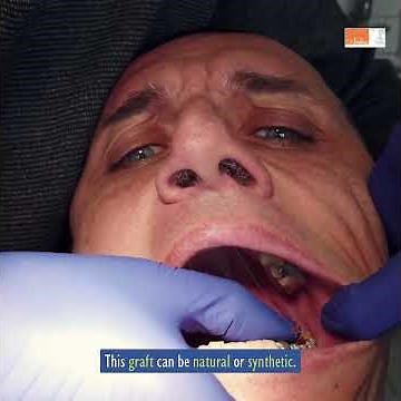 2025 07 22 Socket Preservation Enhancing Healing After Tooth