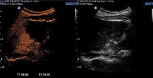 Slow filling hepatic hemangioma (CEUS) | Radiology Case | Radiopaedia.org