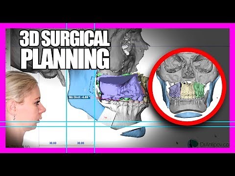 3D Orthognathic Surgical Planning - HOW ITS DONE