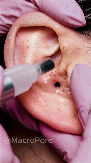 Deep Ear Blackhead Removal | Satisfying Vacuum Extraction ASMR