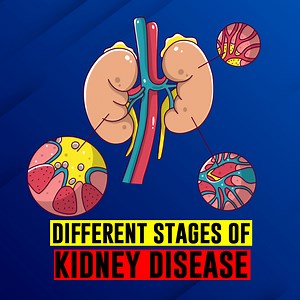 Five stages of Chronic Kidney disease. | Doctor ASKY