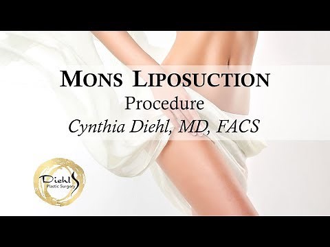 Mons Liposuction | Vaginal Rejuvenation | Diehl Plastic Surgery