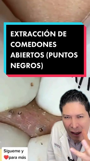 EXTRACCIÓN DE COMEDONES ABIERTOS: Tips y Tratamientos Efectivos