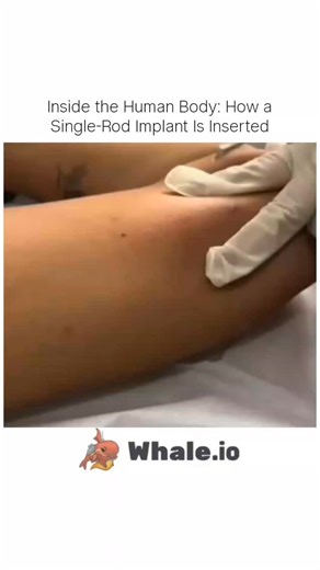 Science on Instagram: "A single-rod implant is carefully placed just beneath the skin using a precise medical technique. This short procedure provides long-term effectiveness with minimal invasion — a fascinating example of how modern medicine works with the human body. . . DM for credit and removal . . #HealthEducation #ScienceReels #trending"