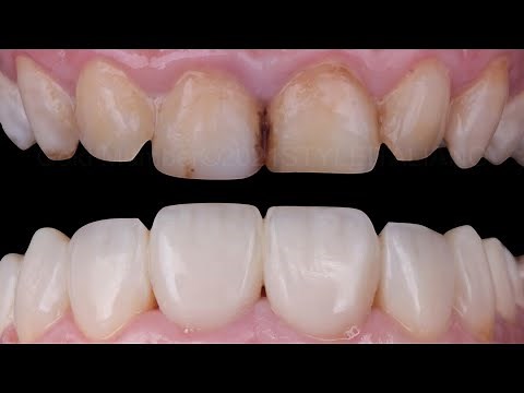Teeth Recontouring and Shape Perfecting by direct composite bonding. (Teeth whitening )