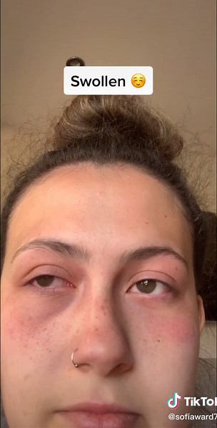 Understanding Eye Conditions: Jelly-Like Substance in Eyes Explained