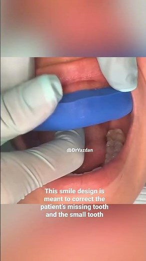 Dental veneer procedure | dental veneers step by step | dental veneers for gapped teeth | Dr. Yazdan