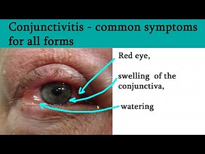 Red or pink eye - Conjunctivitis, symptoms and treatment