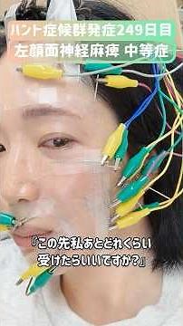 【発症249日目】病的共同運動の治療３回目の翌々日 #顔面神経麻痺 #ハント症候群 #後遺症 #鍼灸院 #リハビリ