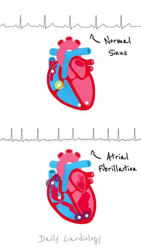 Heart's Conduction in Normal Sinus Rhythm vs Atrial Fibrillation #shorts #ecg #cardiology #afib