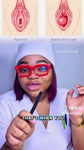 Understanding Bartholin’s Gland Cysts for Women