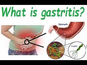 What is gastritis? Causes and symptoms of gastritis