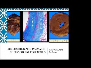 Echocardiographic Assessment and Diagnosis of Constrictive Pericarditis