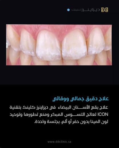 ‎Designer's Clinic - ديزاينرز كلينك‎ on Instagram‎: "علاج بقع الأسنان البيضاء بتقنية ICON DMG من ديزاينرز كلينك تعتمد تقنية ICON Resin Infiltration DMG على التغلغل داخل مينا السن، لتوحيد اللون ومنح نتيجة طبيعية وفورية. ما الذي تعالجه تقنية ICON؟ - علاج بقع الأسنان البيضاء - إيقاف وعلاج التسوس المبكر ومنع تطوّره. - آثار التقويم. - نقص المعادن. - جفاف الفم. تتغلغل مادة Resin Infiltration داخل مينا الأسنان المتأثرة، فتُغلق المسام الدقيقة، تمنع تطوّر التسوس، وتُوحّد لون الأسنان بشكل طبيعي. White Spo
