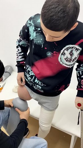 Fitting and Using a Prosthetic Leg: A Personal Journey