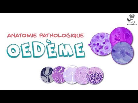 Anatomie Pathologique - l'Oedème