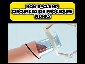How to clip circumcision procedure works