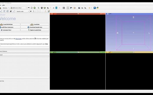 【3D Slicer】自制血管分割插件，从粗分割到断裂修复都有！-柳成荫___-AI-哔哩哔哩视频