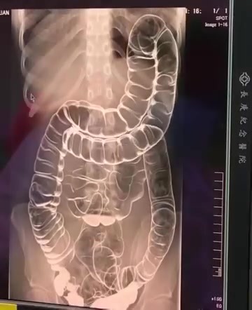 4.5K views · 3 comments | This is an X-ray image of a young woman who suffered from chronic constipation. One day, after experiencing continuous symptoms for over two weeks, she went for a medical check-up and received the X-ray results shown below... | Life with Animals | Facebook