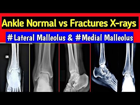 Ankle Fracture X-rays | Fracture Medial , Lateral , Posterior & Both Malleolus | UdayXRay